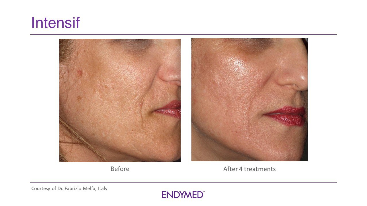 Fotona laser hoito. IPL yhden hoidon jälkeen. 