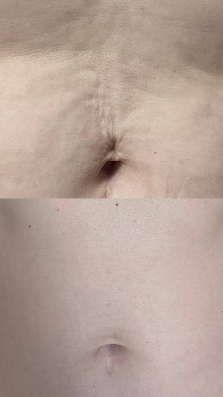  Endymed-hoito. Intensif RF-mikroneulaus. Vatsan alue.