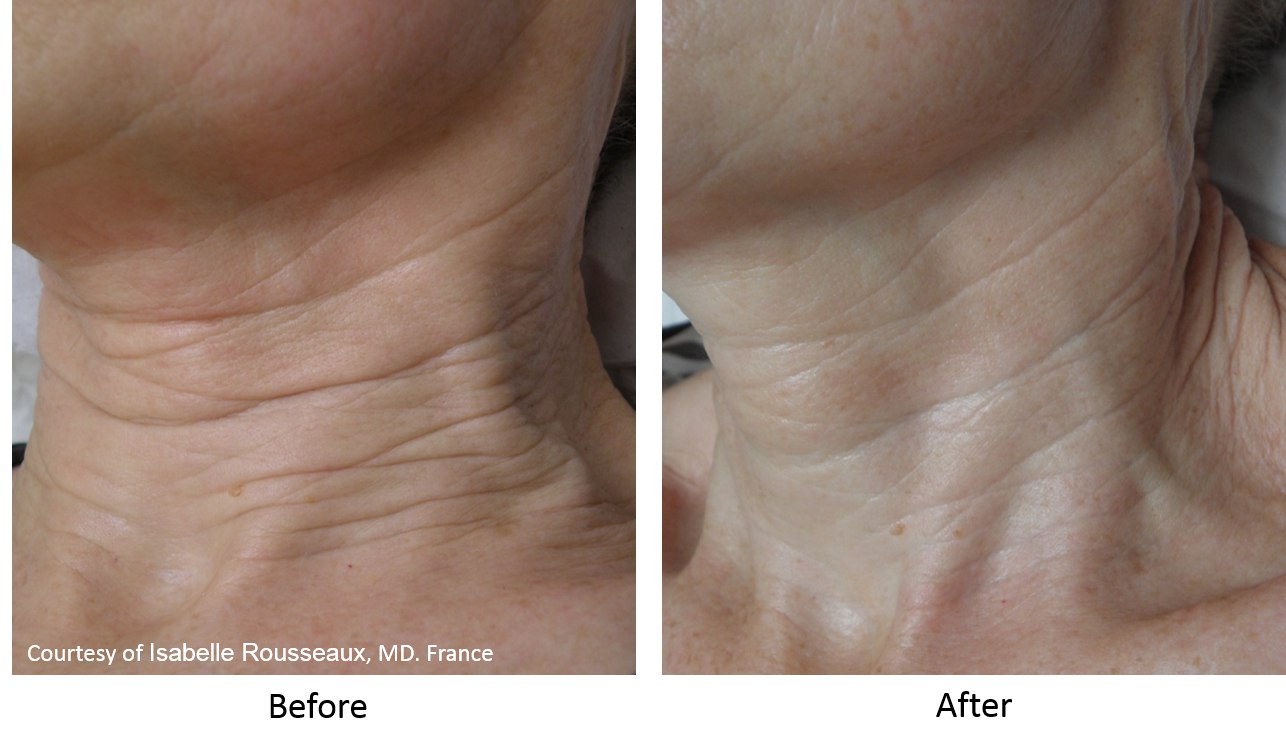 Endymed-hoito. Ei-invasiivinen RF-Lifting