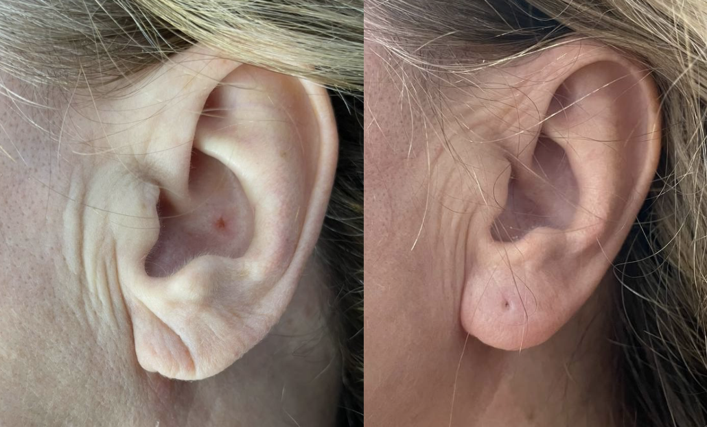 Täyteainehoidot. Korvalehden täyteainehoito