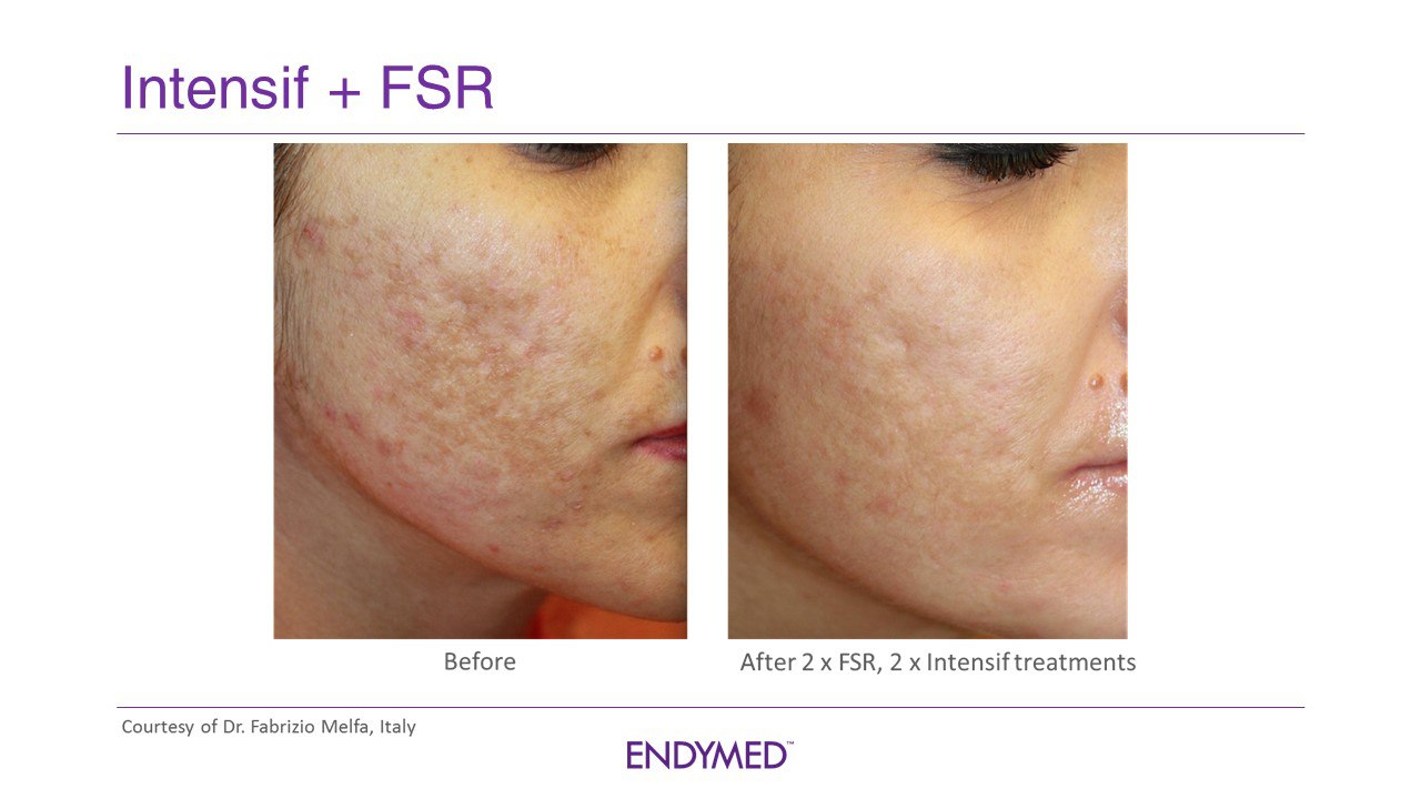 Endymed-hoito. Intensif RF-Mikroneulaus + FSR (fraktionaalinen nuorentaminen)
