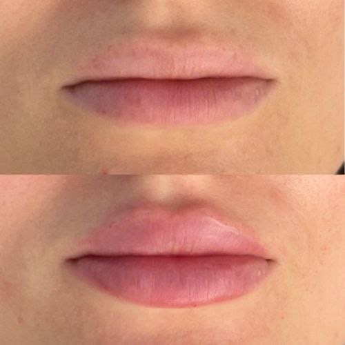 Täyteainehoidot. (Huulten täyttö ja muotoilu)